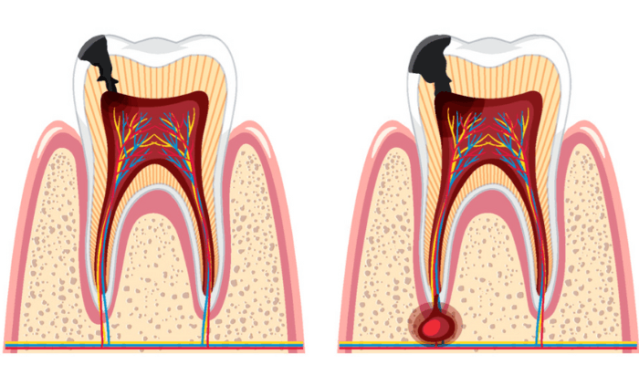Tratamento de canal no dente
