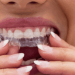 Aparelho invisivel SouSmile