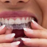 Aparelho invisivel SouSmile
