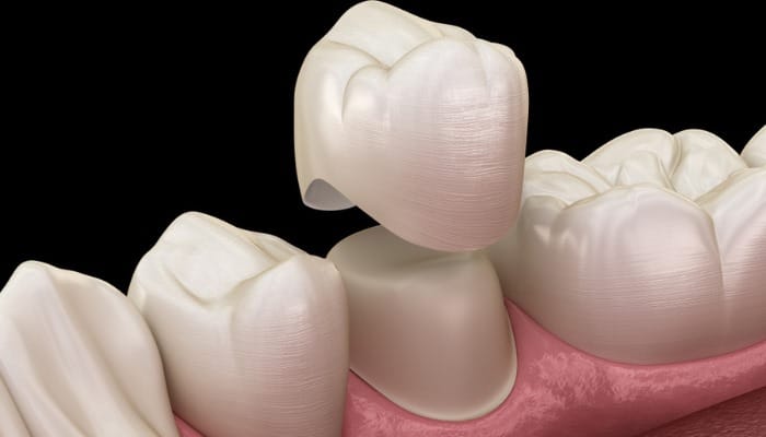 Coroa dental OdontoGama São Paulo Zona Leste