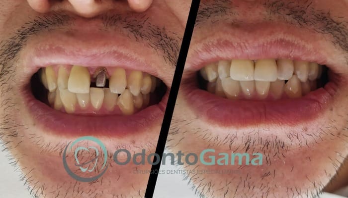 Coroa dentaria Odonto Gama Dentista em São Paulo