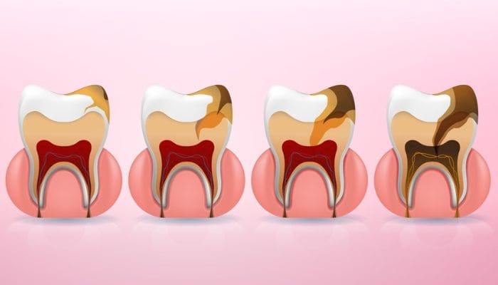 Comprometimento Dental pela Cárie: Fases e Tratamentos Eficazes
