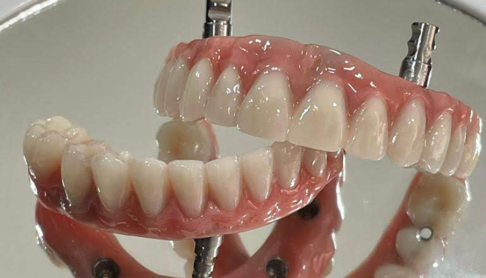 Implante Dentário com Carga Imediata