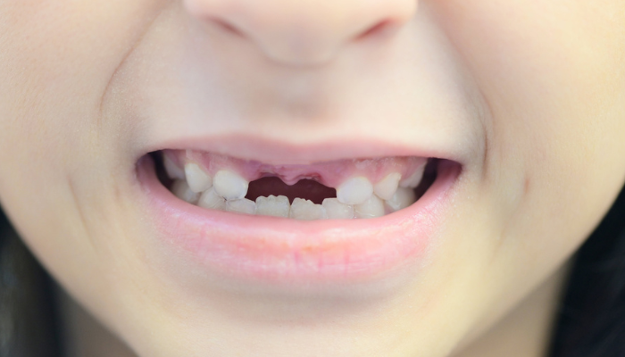 Arrancar dentes de leite em casa pode causar infecções e prejudicar os dentes permanentes. Saiba como evitar complicações.