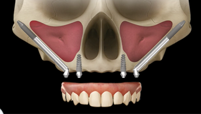 implantes zigomáticos com técnica exteriorizada para reabilitação oral
