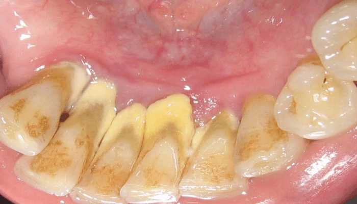 Tartaro nos dentes