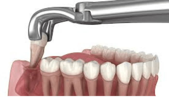 cirurgia de extração do dente do siso