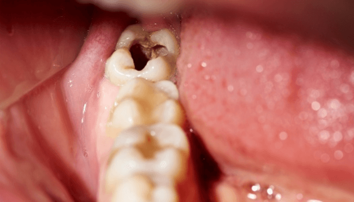 Cárie dental