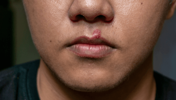 Herpes labial