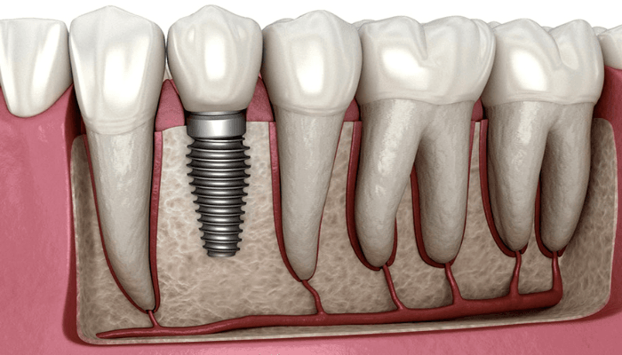 Implantes Dentários em São Paulo - Odonto Gama
