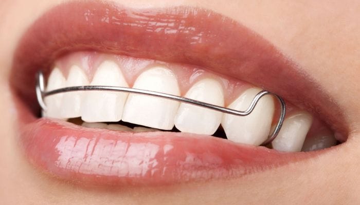 Contenção ortodontica odonto gama