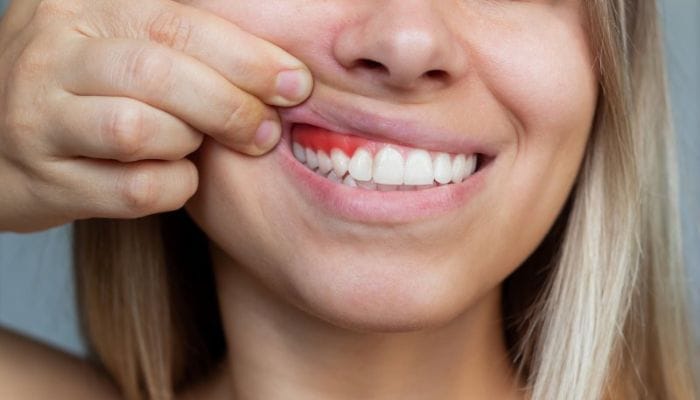 Especialista em tratamento para gengivite