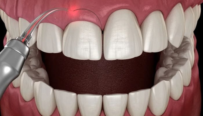 Gengivoplastia Odontogama