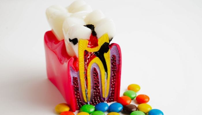 Retratamento de canal odontogama