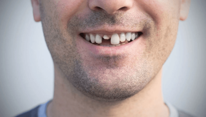 Dentista para dente quebrado