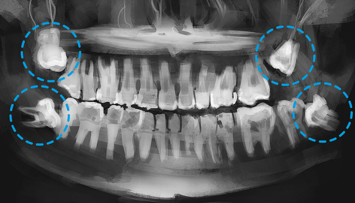 dente-siso
