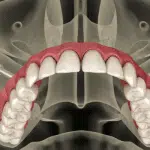 Implante Zigomático: o Que É e Como Pode Transformar Seu Sorriso Definitivamente
