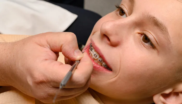 Tratamento com aparelho autoligado