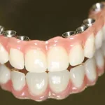 Dentadura x Prótese Protocolo: Qual a Melhor Opção?