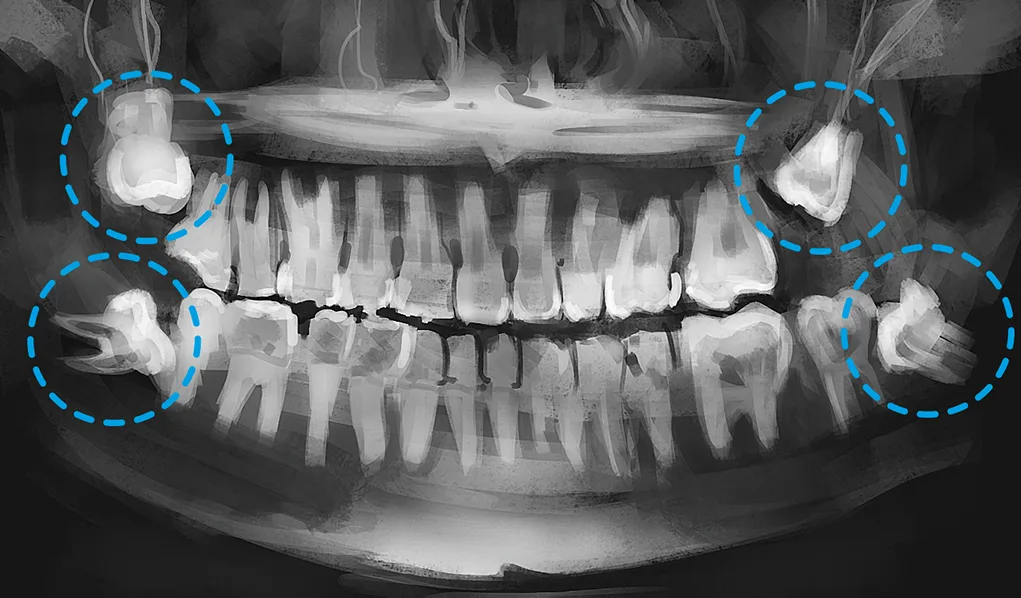 Dente do siso impactado: complicações e como tratar