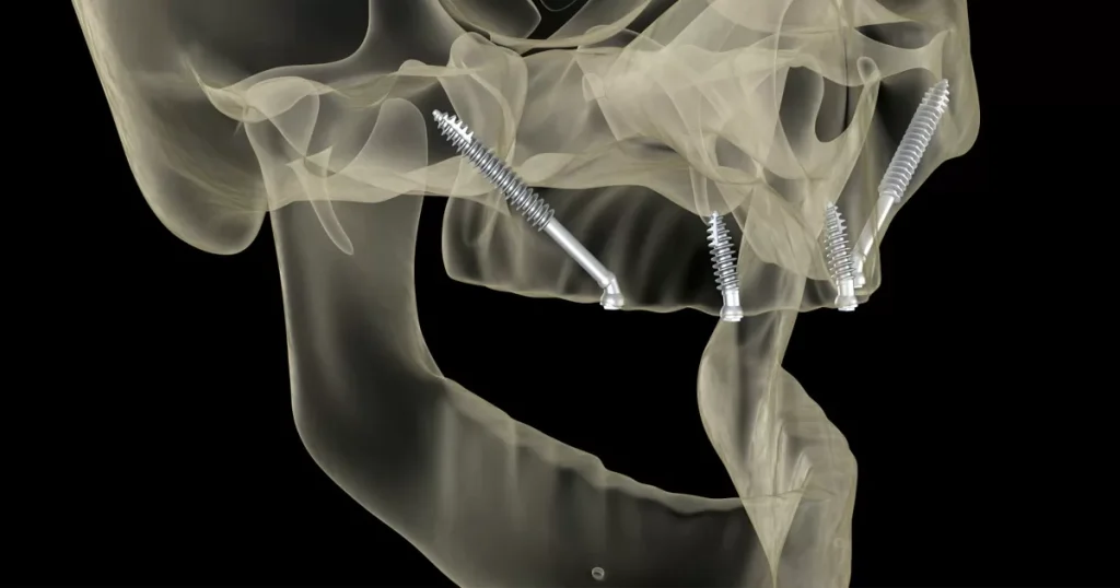 Tudo sobre Implante Zigomático