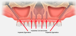 Implantes Zigomáticos: A Solução em Implantodontia para Maxila Atrófica na Zona Leste de SP