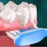 Limpeza de Protocolo: Guia Completo Para Garantir a Saúde do Seu Implante Fixo