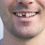 Como funciona a prótese fixa de 1 dente? Veja como recuperar a estética e a mastigação com conforto. OdontoGama Vila Matilde é referência!