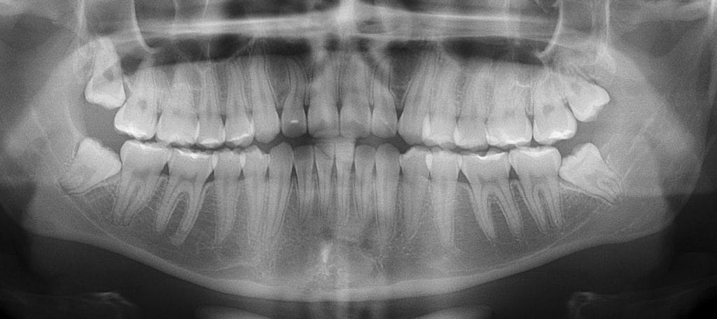 Dente incluso: preciso tirar? Saiba tudo antes que vire um problema grave