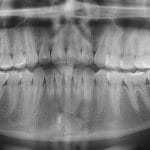 Dente incluso: preciso tirar? Saiba tudo antes que vire um problema grave
