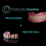  Prótese Protocolo ou Dentadura? Diferenças e Vantagens que Você Precisa Conhecer