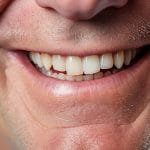 Cuidados Diários com a Prótese Protocolo: Dicas de Dentista