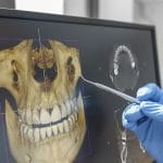Mitos e Verdades sobre Prótese Protocolo: O que a Odontologia Diz
