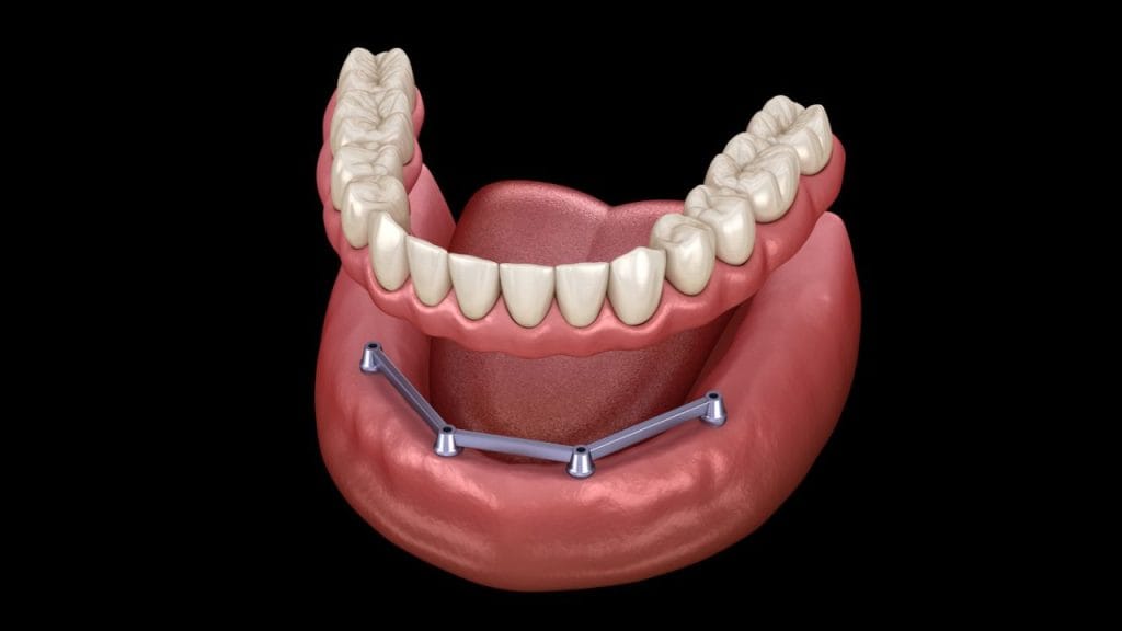 Overdenture barra clipe: vantagens estéticas e funcionais que você precisa conhecer