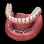 Overdenture barra clipe: vantagens estéticas e funcionais que você precisa conhecer