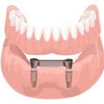 Overdenture barra clip: a solução moderna para reabilitar o sorriso com segurança