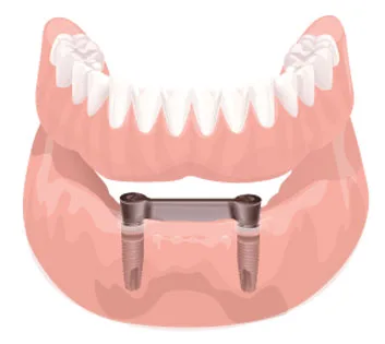 Overdenture barra clip: a solução moderna para reabilitar o sorriso com segurança