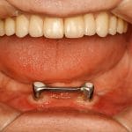 Como a overdenture barra clipe transforma mastigação e qualidade de vida
