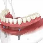 Como funciona a overdenture barra clip e quando ela é indicada
