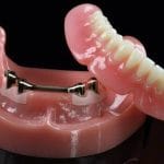 Guia completo sobre overdenture barra clipe: o que é, benefícios e indicações
