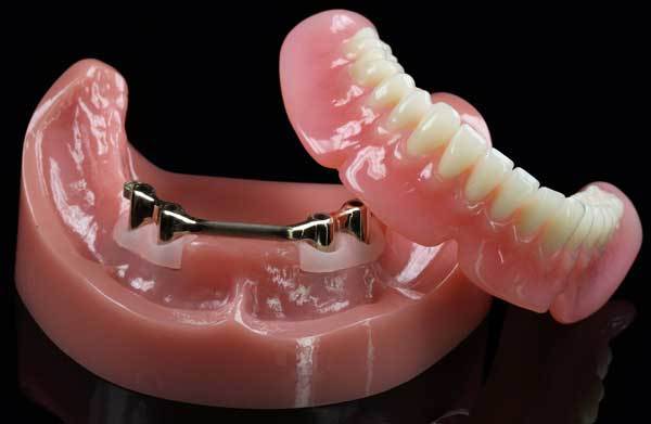 Guia completo sobre overdenture barra clipe: o que é, benefícios e indicações