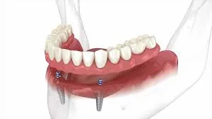 Como funciona a overdenture barra clip e quando ela é indicada